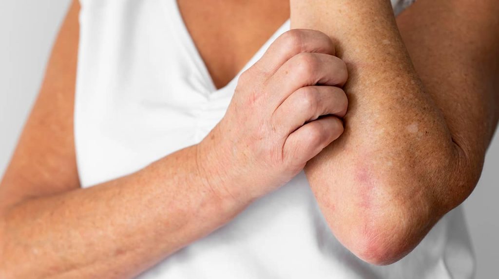 Curare la dermatite atopica con CBD e altri rimedi naturali