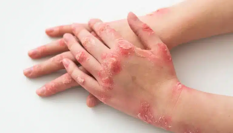 CBD psoriasi