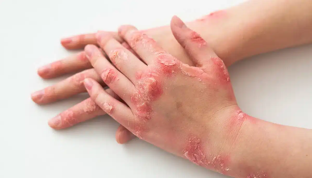 CBD psoriasi